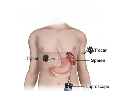 Splenic Disorders Requiring Surgery (Haematological Conditions) consultation at Niraaya Hospital